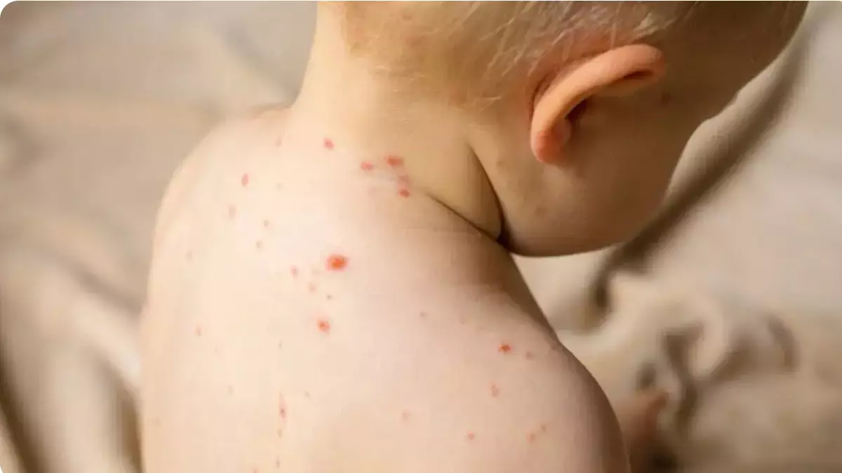 Бангладеште қызылша өршіп, бір айда 100 бала көз жұмды