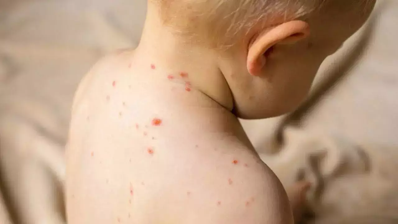 Бангладеште қызылша өршіді: бір айда 100-ден астам бала қайтыс болды