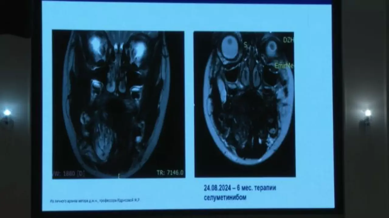 Специалисты в области неврологии обменялись опытом в Астане