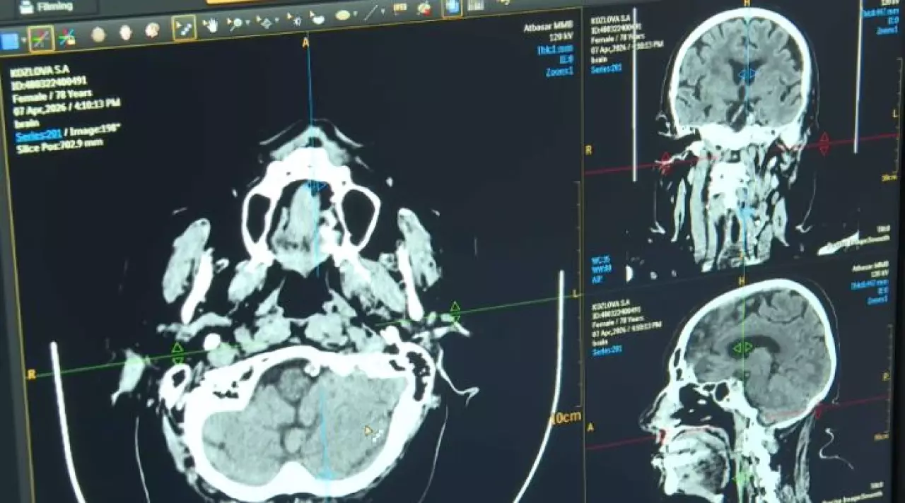 ИИ помогает при диагностике инсульта