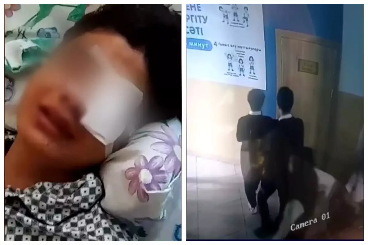 Тараздық оқушы төбелестен кейін көзінен айырылды