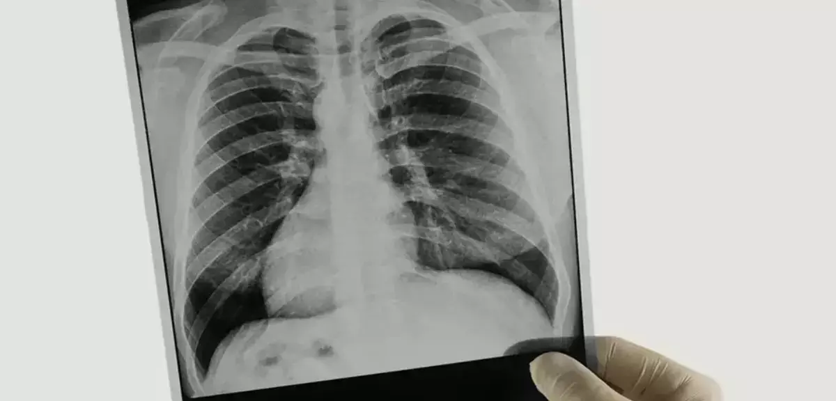 Общая статистика по туберкулезу сократилась в Актау - новости на Lada.kz 16.04.2026