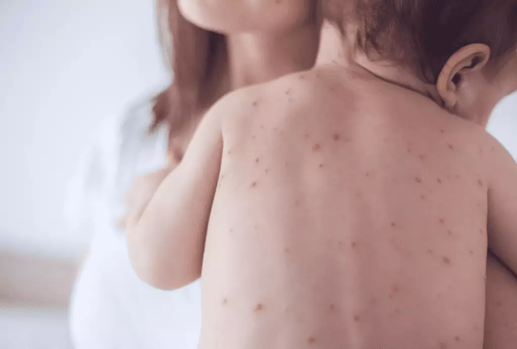 В Казахстане за неделю почти на треть снизилось число новых случаев кори