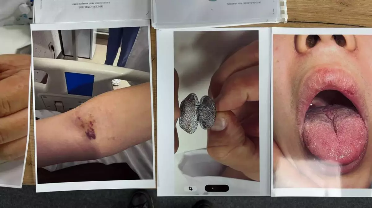 "Жүрегіне салынған имплант түсіп кеткен": Алматыда сәтсіз отаның кесірінен 20 жастағы жігіт жансақтау бөліміне түскен