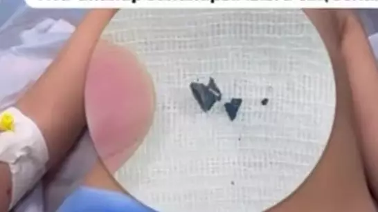 Алматыда дәрігерлер 5 жасар баланың өкпесінен тирдың оғын алып шықты