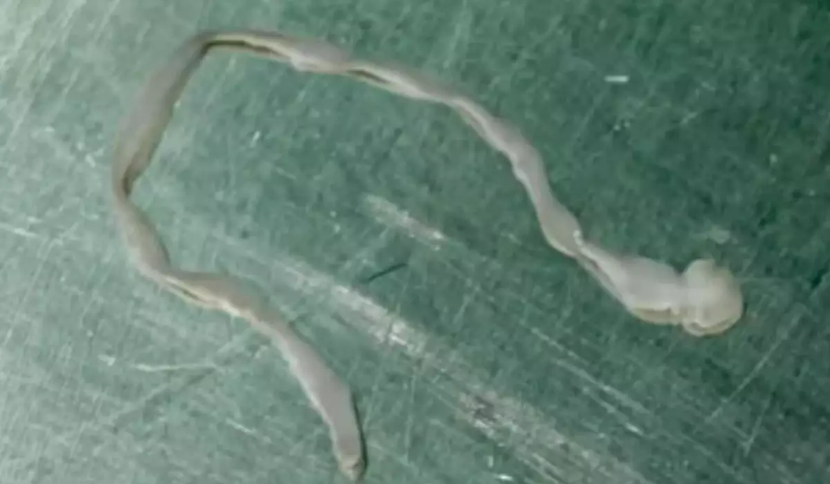 Әйелдің миынан ұзындығы сегіз сантиметрлік құрт табылды