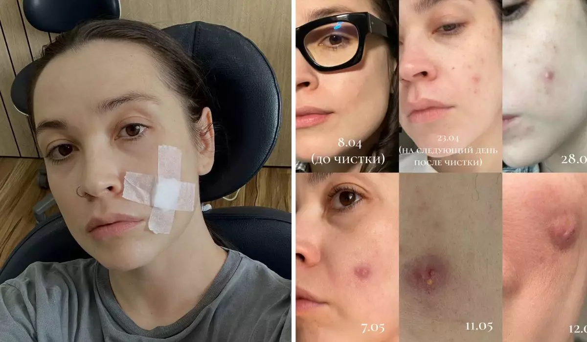 Бетін тазалатамын деп косметологқа барған астаналық әйелдің бетінде 1,5 сантиметрлік тыртық қалды