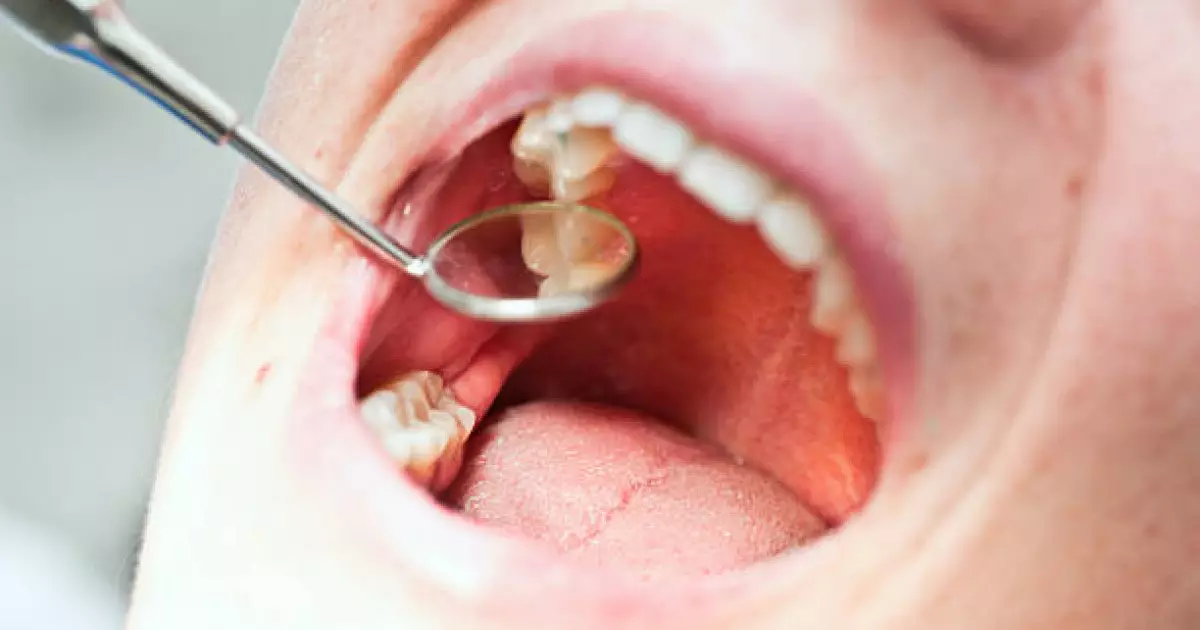  Тіс дәрігері жасырын тіс жегі белгілерін атады 