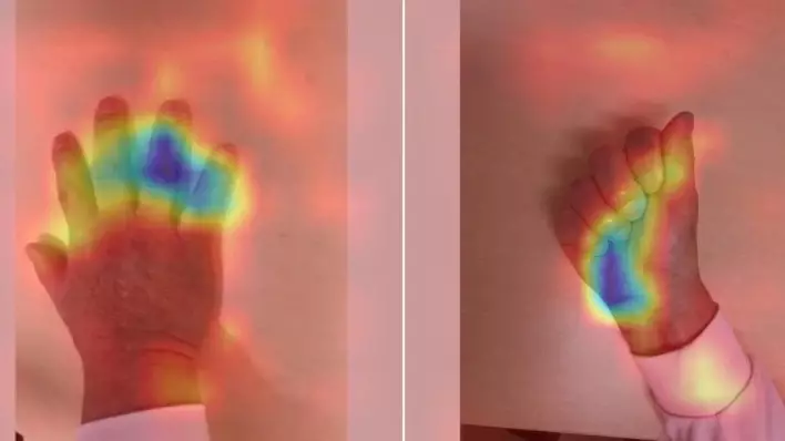 Учёные создали ИИ, способный выявлять гормональное заболевание по фото руки