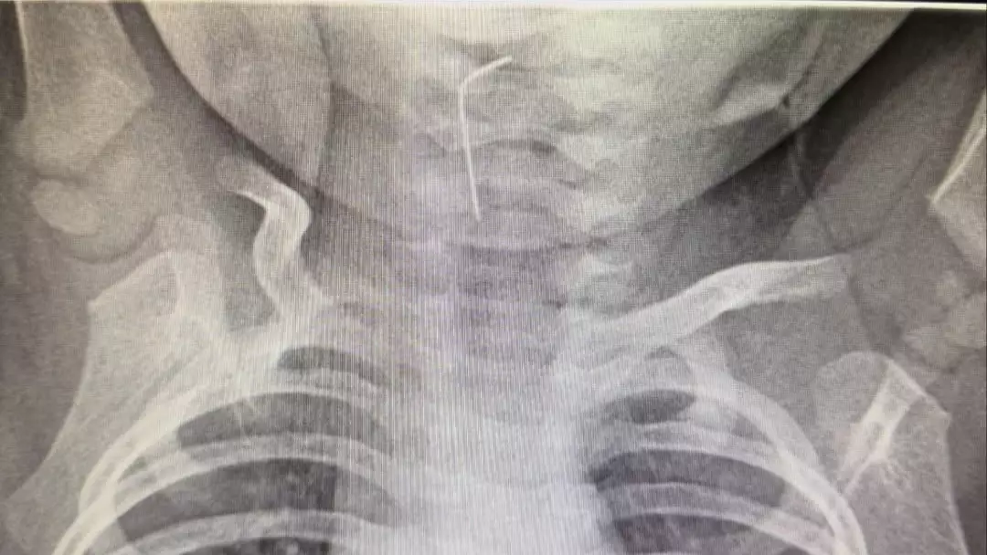 Түркістанда жантүршігерлік оқиға: 9 айлық сәби ине жұтып қойды