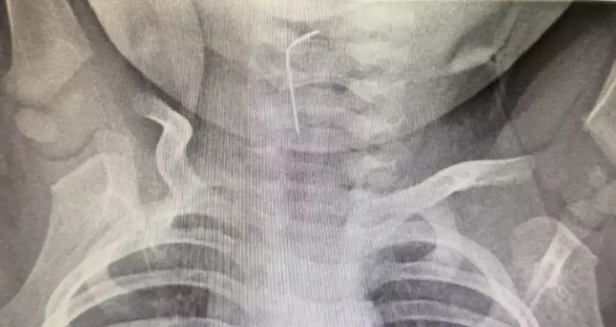 Түркістанда 9 айлық сәби ине жұтып қойды