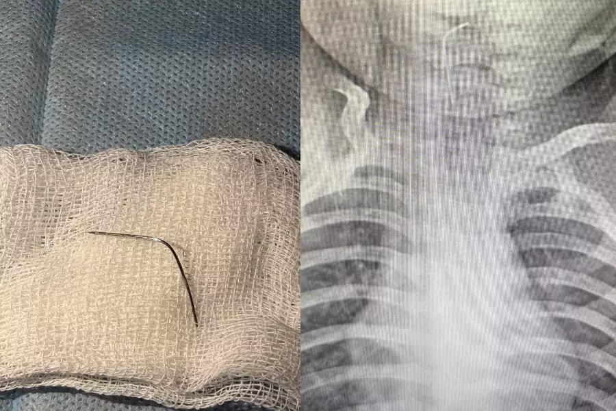 Түркістан облысында 9 айлық сәби ине жұтып қойған