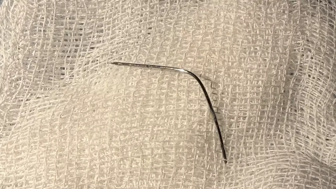 Таңғаларлық жағдай: Түркістан облысында ине жұтқан сәби аман қалды