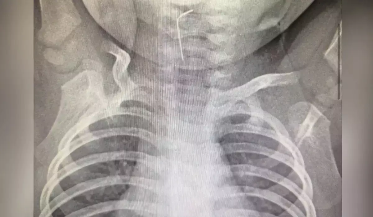 Түркістан облысында тоғыз айлық сәби ине жұтып қойған