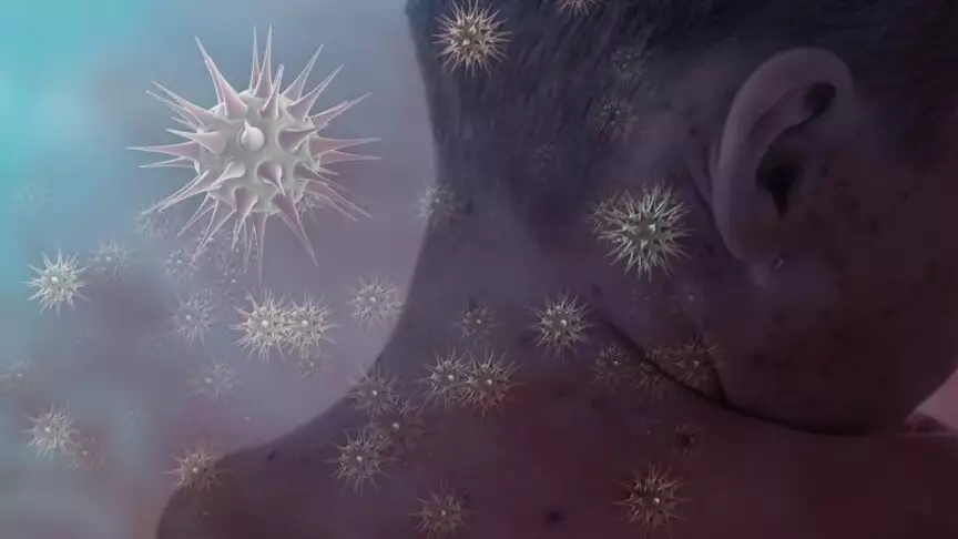 Қызылша індетінен 15 бала көз жұмды