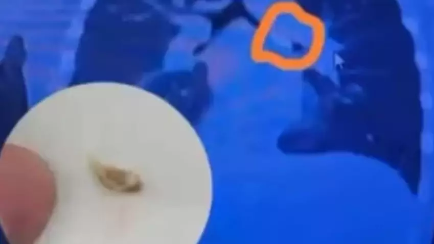 Алматыда картоп пюресін жеп, шашалып қалған баланың өкпесінен сүйек шықты