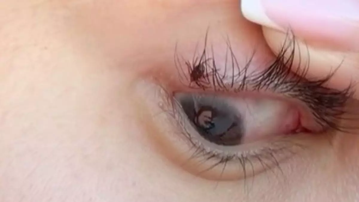 Алматинка обнаружила клеща в своих ресницах