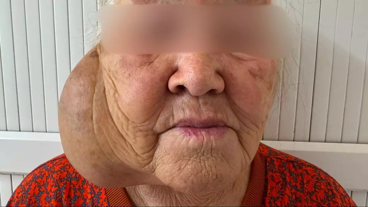 «Тыныс алу қиындады»: 10 жыл бойы алып ісікпен өмір сүрген қазақстандыққа ота жасалды
