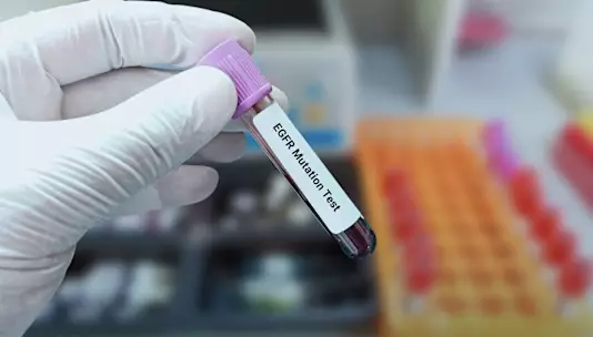 AstraZeneca и Abbisko сотрудничают в проведении клинического исследования комбинированной терапии немелкоклеточного рака легкого.