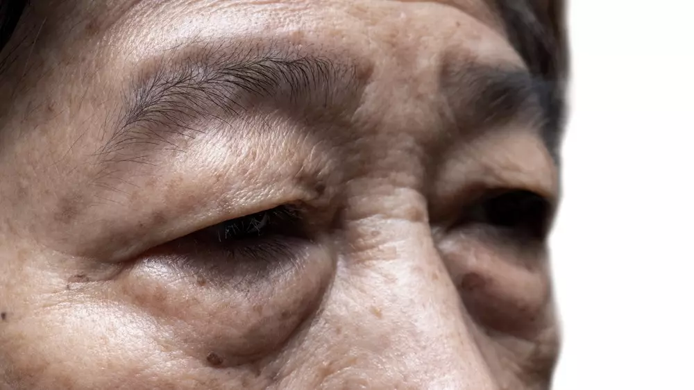 Беттегі қандай белгілер холестериннің жоғарылағанын көрсетуі мүмкін?