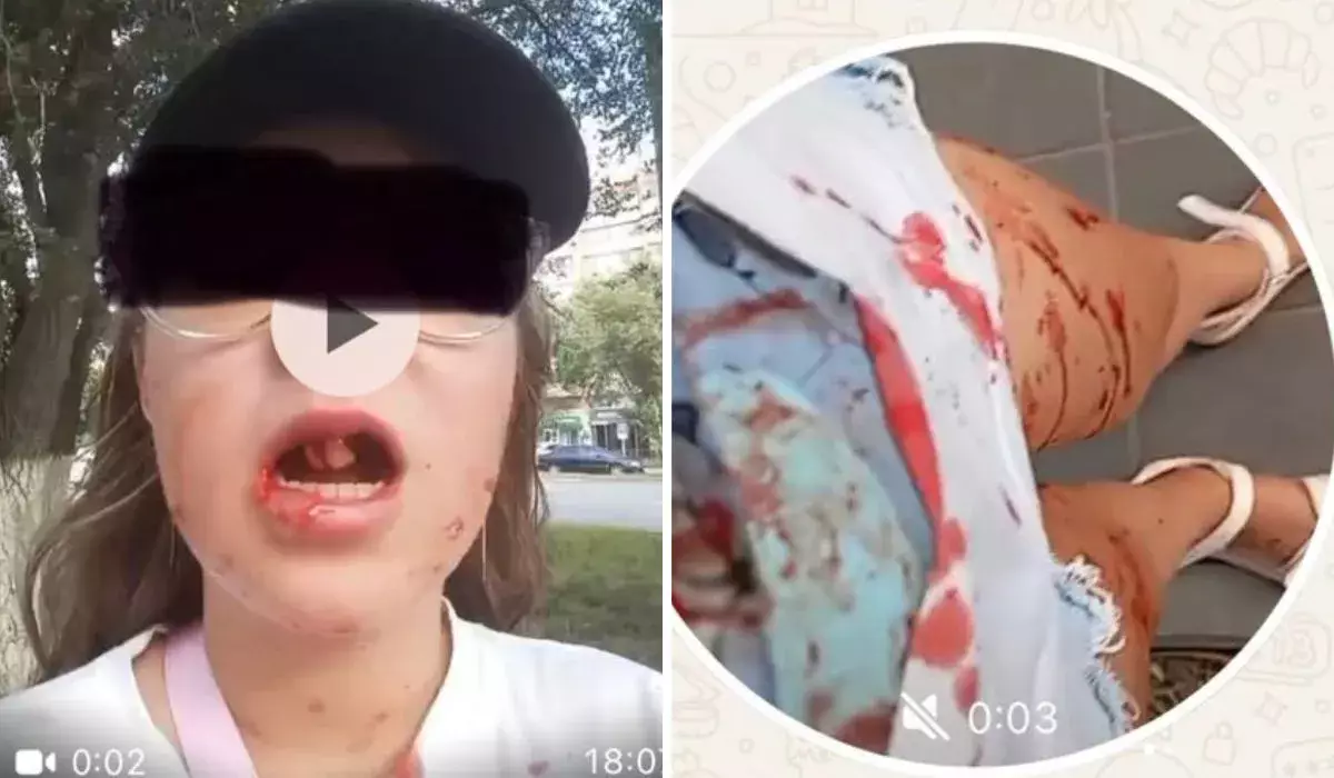 "Жақ сүйегі сынып, тістері түскен": Ақтөбеде велокурьер 12 жастағы қызды қағып, қашып кеткен